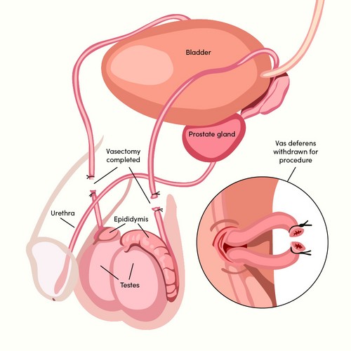 Vasectomy diagram